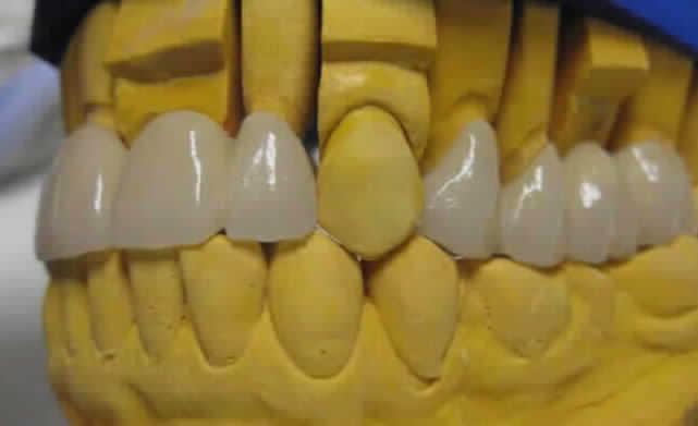 Răng giả